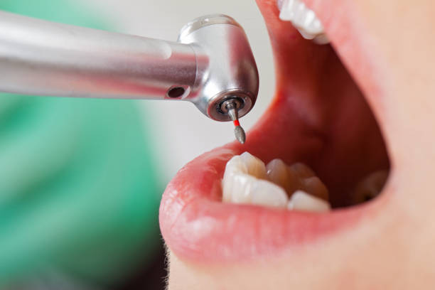 Best Emergency Wisdom Teeth Removal in Thorofare, NJ